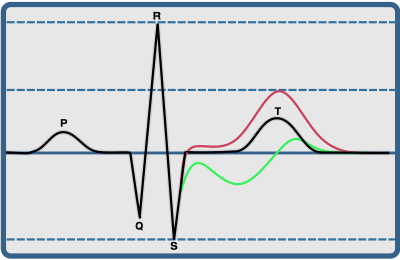 PQRST segment showing elevated and biphasic ST-segment